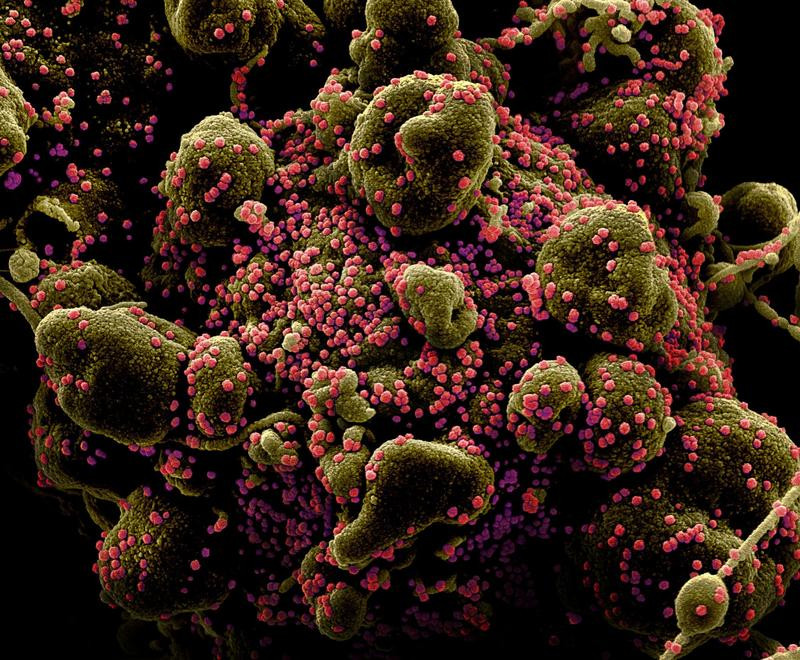ColoriSed scanning electron micrograph of an apoptotic cell (greenish brown) heavily infected with SARS-COV-2 virus particles (pink), also known as novel coronavirus, isolated from a patient sample. Image captured and color-enhanced at the NIAID Integrated Research Facility (IRF) in Fort Detrick, Maryland. National Institute of Allergy and Infectious Diseases. PHOTO: REUTERS/FILE
