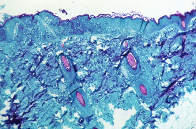 monkeypox presents moderate risk to public health who says monkeypox presents moderate risk to public health who says