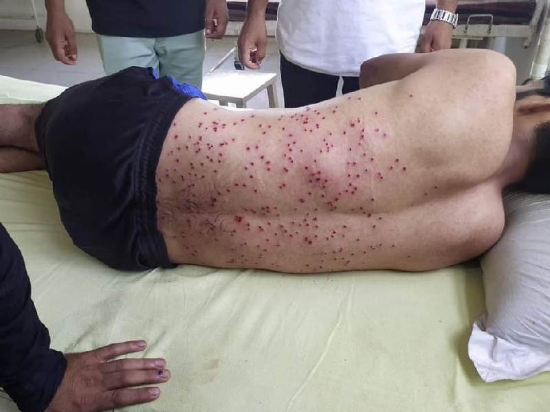 a shia muslim youth lies on a hospital bed with pellets injures fired by the indian forces today during muharram procession in srinagar photo twitter ahmermkhan