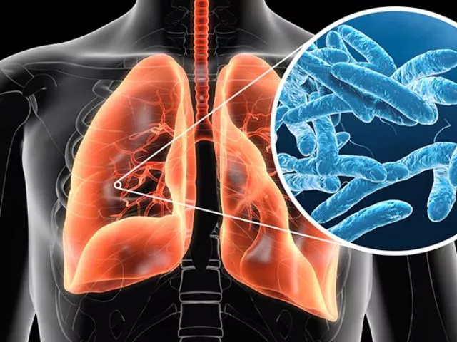 legionnaires disease legionnaires disease