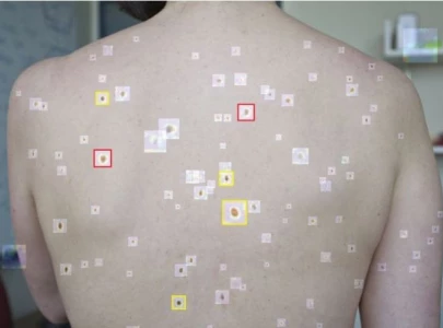 this ai tool can help detect cancer this ai tool can help detect cancer