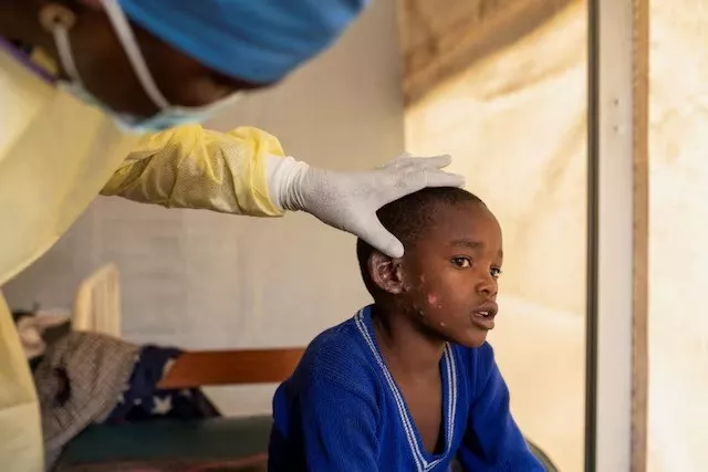 patient suffering from mpox at the treatment centre in munigi a democratic republic of congo july 19 2024 photo reuters patient suffering from mpox at the treatment centre in munigi a democratic republic of congo july 19 2024 photo reuters