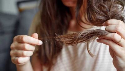 pcos and hair loss understanding the causes symptoms treatment options