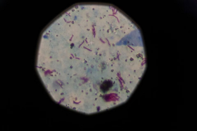 a sample that tested positive for tuberculosis is seen from a microscope march 29 2019 photo reuters a sample that tested positive for tuberculosis is seen from a microscope march 29 2019 photo reuters