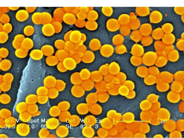 image superbug crisis