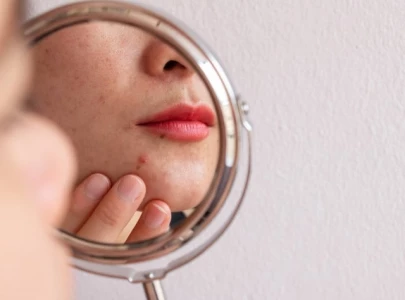 understanding menstrual and hormonal acne causes effects and how to manage it understanding menstrual and hormonal acne causes effects and how to manage it