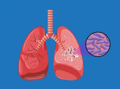 expert calls for preventive steps to combat tb expert calls for preventive steps to combat tb