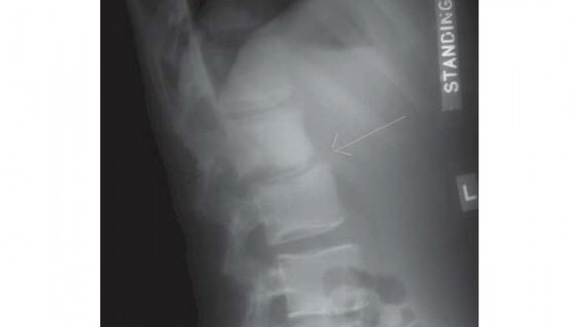 tuberculosis attacks the spine in 6 out of every 10 cases tuberculosis attacks the spine in 6 out of every 10 cases