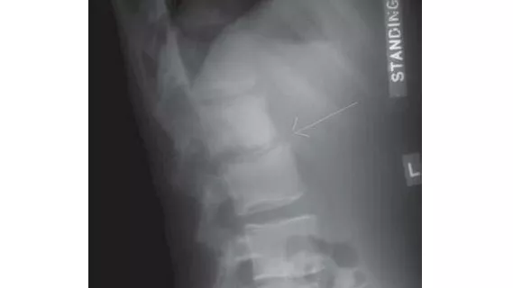 tuberculosis attacks the spine in 6 out of every 10 cases tuberculosis attacks the spine in 6 out of every 10 cases