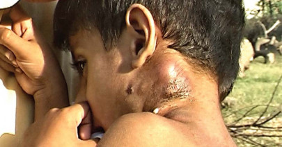 time running out for kids suffering from phantom disease time running out for kids suffering from phantom disease