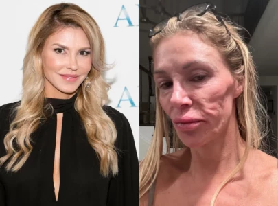 brandi glanville reveals health battle with facial swelling caused by possible parasite or stress