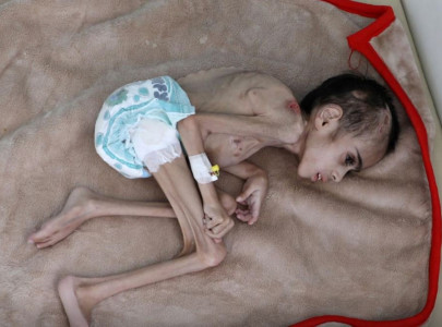 yemeni boy ravaged by hunger weighs 7 kg
