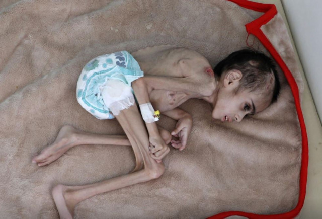 yemeni boy ravaged by hunger weighs 7 kg yemeni boy ravaged by hunger weighs 7 kg
