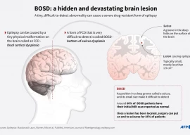 ai tool helps researchers treat child epilepsy ai tool helps researchers treat child epilepsy