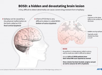 ai tool helps researchers treat child epilepsy