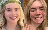 former pageant queen opens up about severe acne struggles cysts the size of grapes