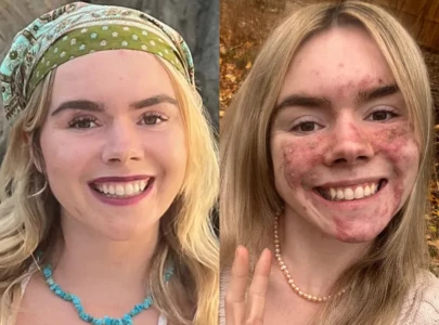 former pageant queen opens up about severe acne struggles cysts the size of grapes