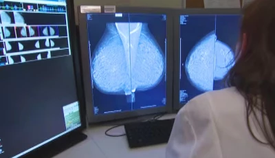 federal health minister urges breast cancer screening