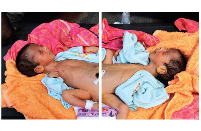 conjoined twins readmitted to hospital after protest conjoined twins readmitted to hospital after protest
