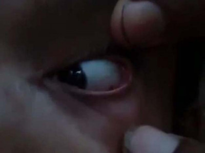 60 ants removed from 11 year old girl s eye in india 60 ants removed from 11 year old girl s eye in india