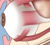 newborn survives rare eye tumour newborn survives rare eye tumour