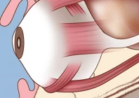 newborn survives rare eye tumour