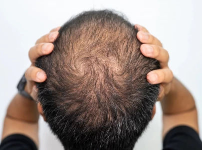 premature balding 9 reasons behind why you re experiencing hair loss in your 20 s