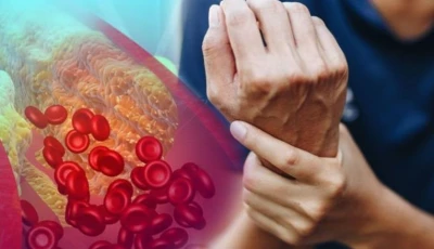 uncommon signs of high cholesterol in your hands