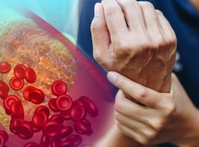 uncommon signs of high cholesterol in your hands uncommon signs of high cholesterol in your hands
