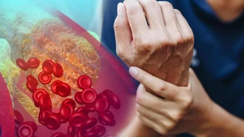 uncommon signs of high cholesterol in your hands