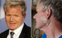 chef gordon ramsay undergoes surgery for basal cell carcinoma urges sun safety chef gordon ramsay undergoes surgery for basal cell carcinoma urges sun safety