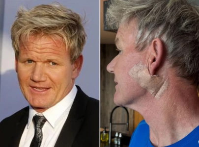 chef gordon ramsay undergoes surgery for basal cell carcinoma urges sun safety chef gordon ramsay undergoes surgery for basal cell carcinoma urges sun safety