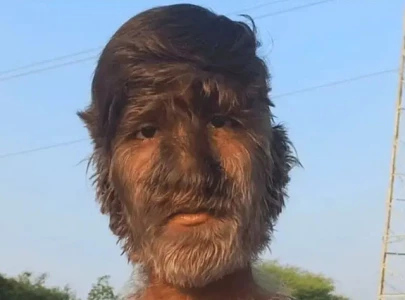 indian teen with rare condition sets guinness record for hairiest face indian teen with rare condition sets guinness record for hairiest face