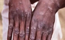 new monkeypoxcase reported in city