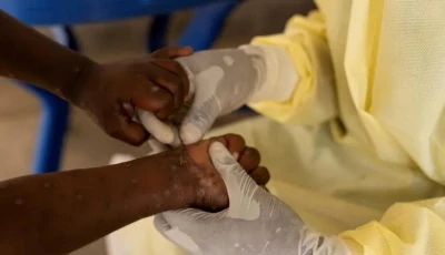 mpox outbreak causes symptoms treatment prevention