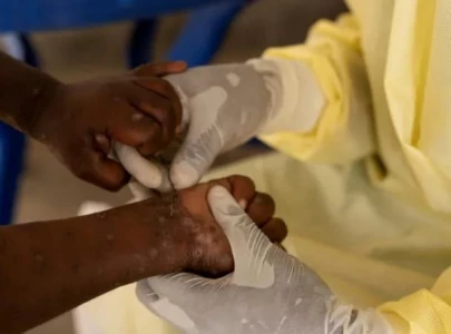 mpox outbreak causes symptoms treatment prevention mpox outbreak causes symptoms treatment prevention