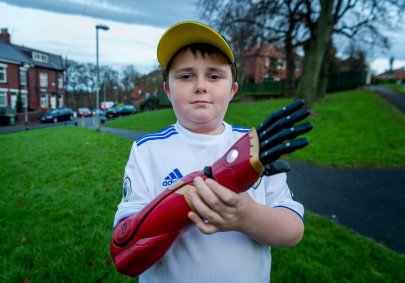 mystery donor helps uk boy get 10 000 bionic iron man arm mystery donor helps uk boy get 10 000 bionic iron man arm
