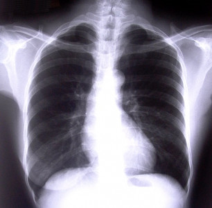 ct scans cut lung cancer deaths by 20 study