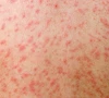 bangladesh measles toll nears grim 1 000 child mark bangladesh measles toll nears grim 1 000 child mark