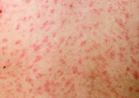 bangladesh measles crisis deepens as child deaths reach 194