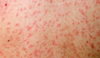 bangladesh measles toll nears grim 1 000 child mark