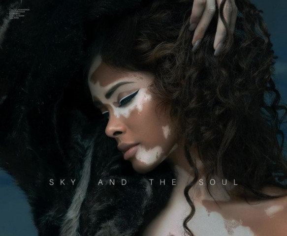 doing it for the gram lsa nominated photographer draws flack for faking vitiligo on model