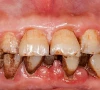 oral cancer surge alarms province oral cancer surge alarms province