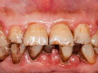oral cancer surge alarms province