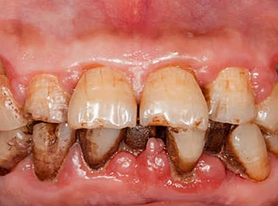 oral cancer surge alarms province oral cancer surge alarms province
