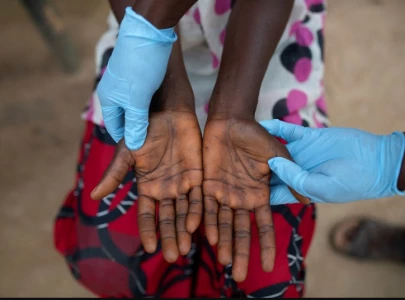 third mpox suspect tests negative third mpox suspect tests negative