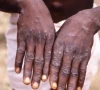 monkeypox outbreak spreads in sindh