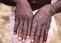monkeypox mpox symptoms include fever rashes and swollen lymph nodes photo afp