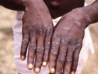 monkeypox mpox symptoms include fever rashes and swollen lymph nodes photo afp