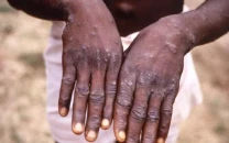 mpox cases detected in newborns in pakistan